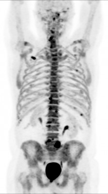 фторид Метастазы