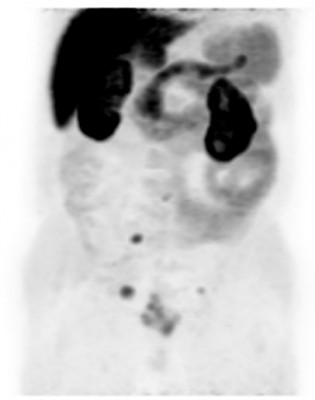 Холин Метастазы рака предстательной железы-1