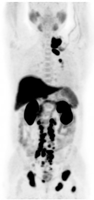 Холин Метастазы рака предстательной железы-2