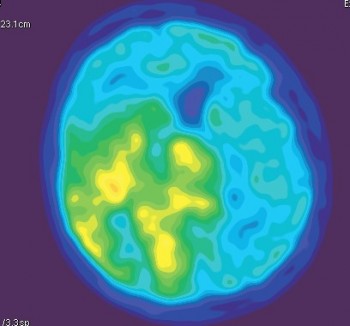 Анапластическая астроцитома