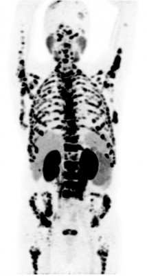 Метастазы в кости скелета при раке предстательной железы