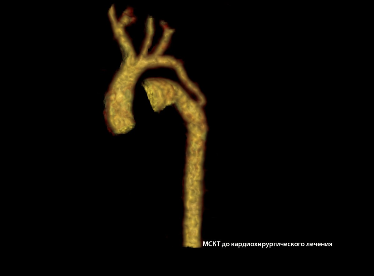 МСКТ до операции