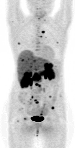 Метастазы нейроэндокринной опухоли