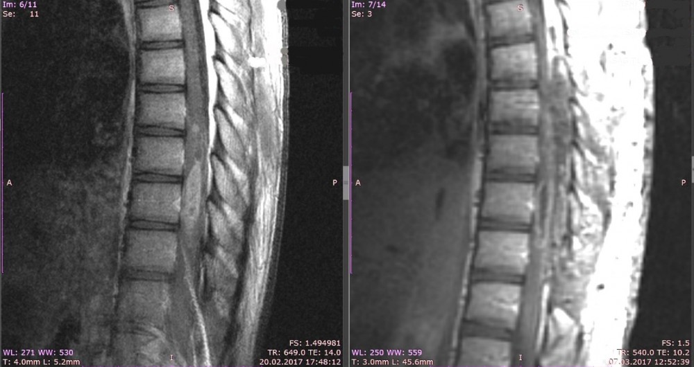 Злокачественные опухоли спинного мозга-2