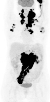 Патологические очаги при лимфоме_фдг