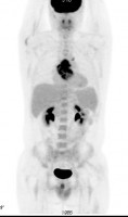 Инфицированная парапротезная гематома у пациента после протезирования восходящего отдела аорты