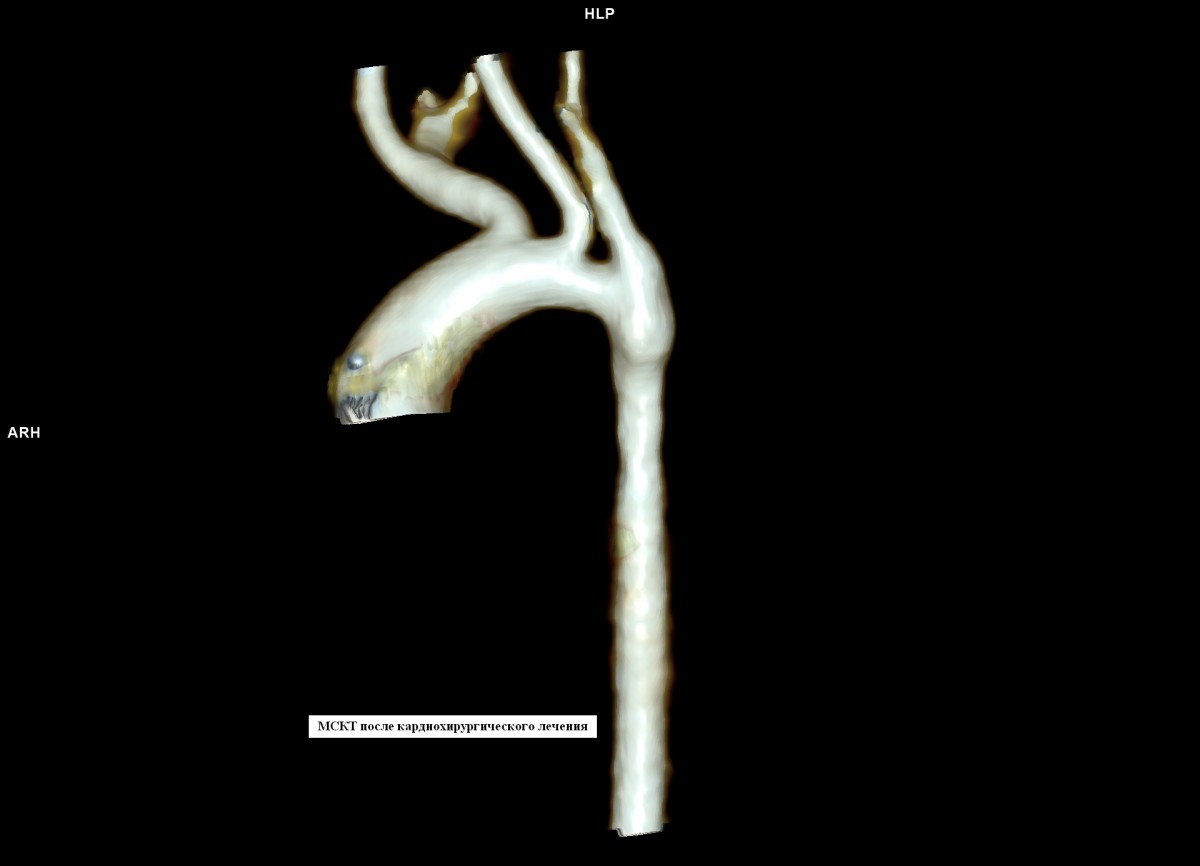 МСКТ после операции корр