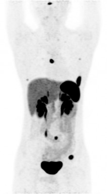 Метастазы при нейроэндокринной опухоли