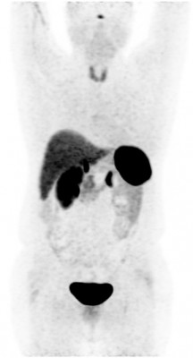 Нормальное распределение РФП в организме