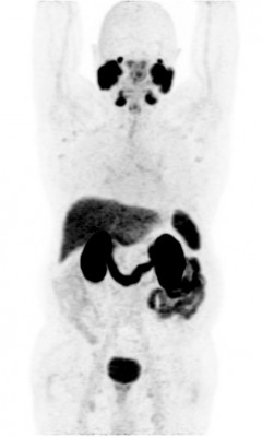 Нормальное распределение РФП в организме