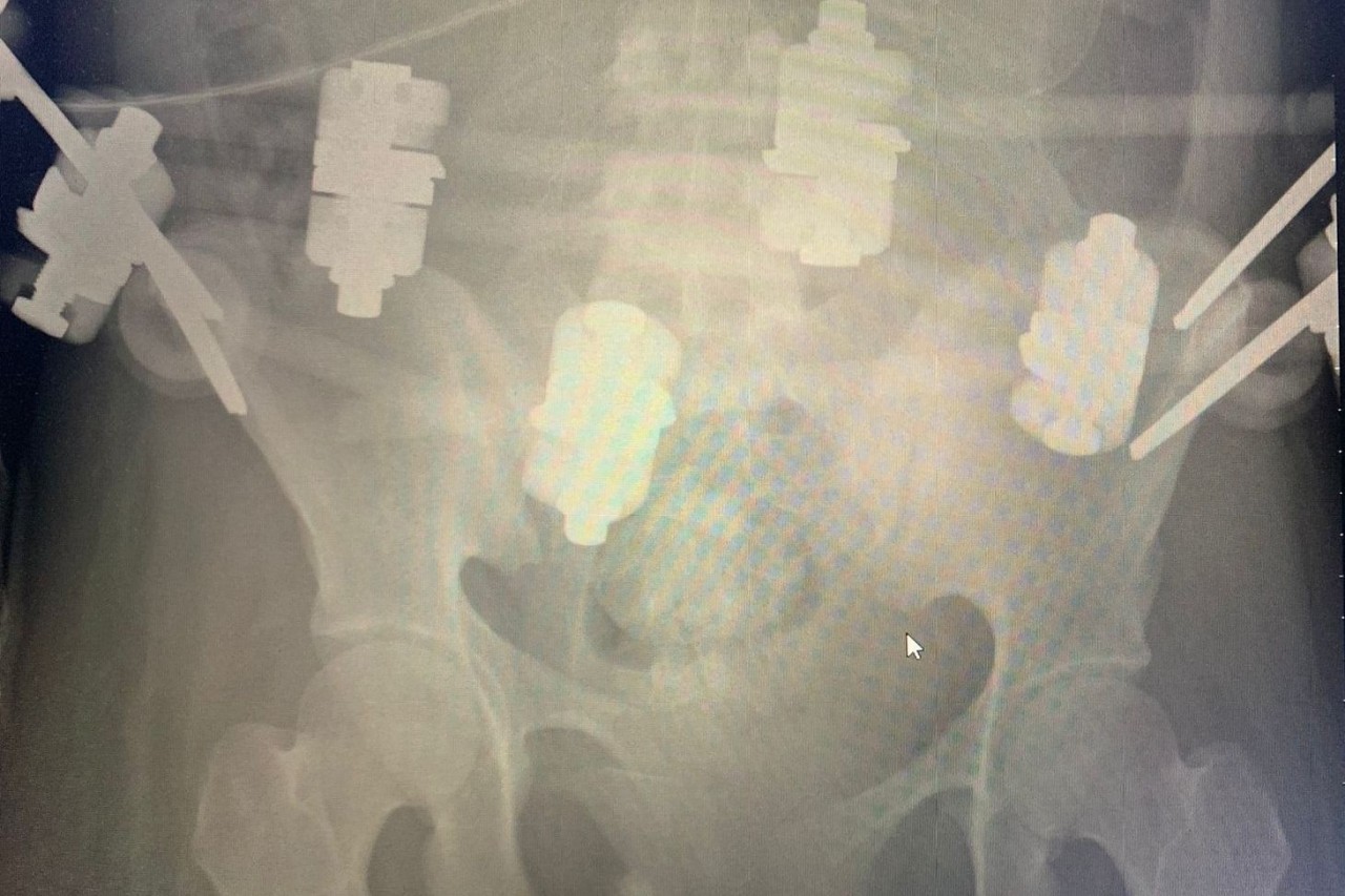 Рентген-снимок костей таза1