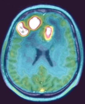 Лимфома центральной нервной системы