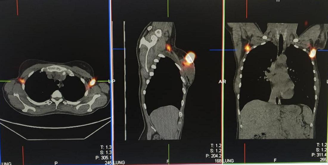 6 Данные сцинтиграфи и афект сторожевых лимфатических узлов_0_0