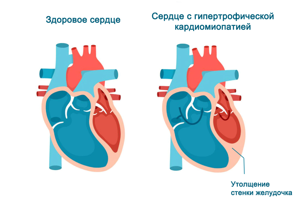 Gip_cardiomiopatia