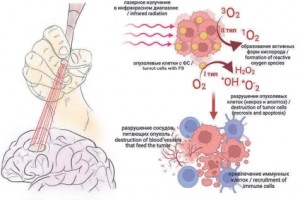 Neuro-oncology page Fig.2