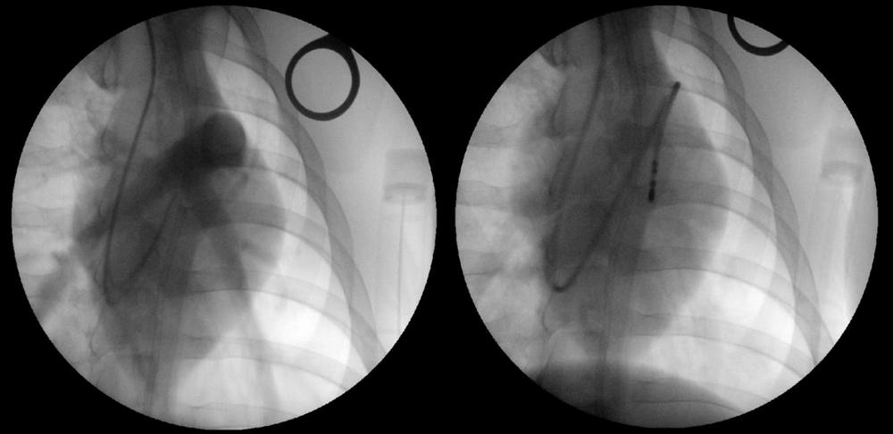 diagnostika legochnoi gipertenzii-2_0