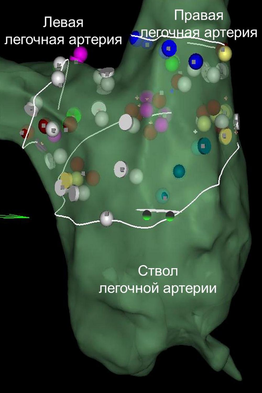 diagnostika legochnoi gipertenzii-3_0