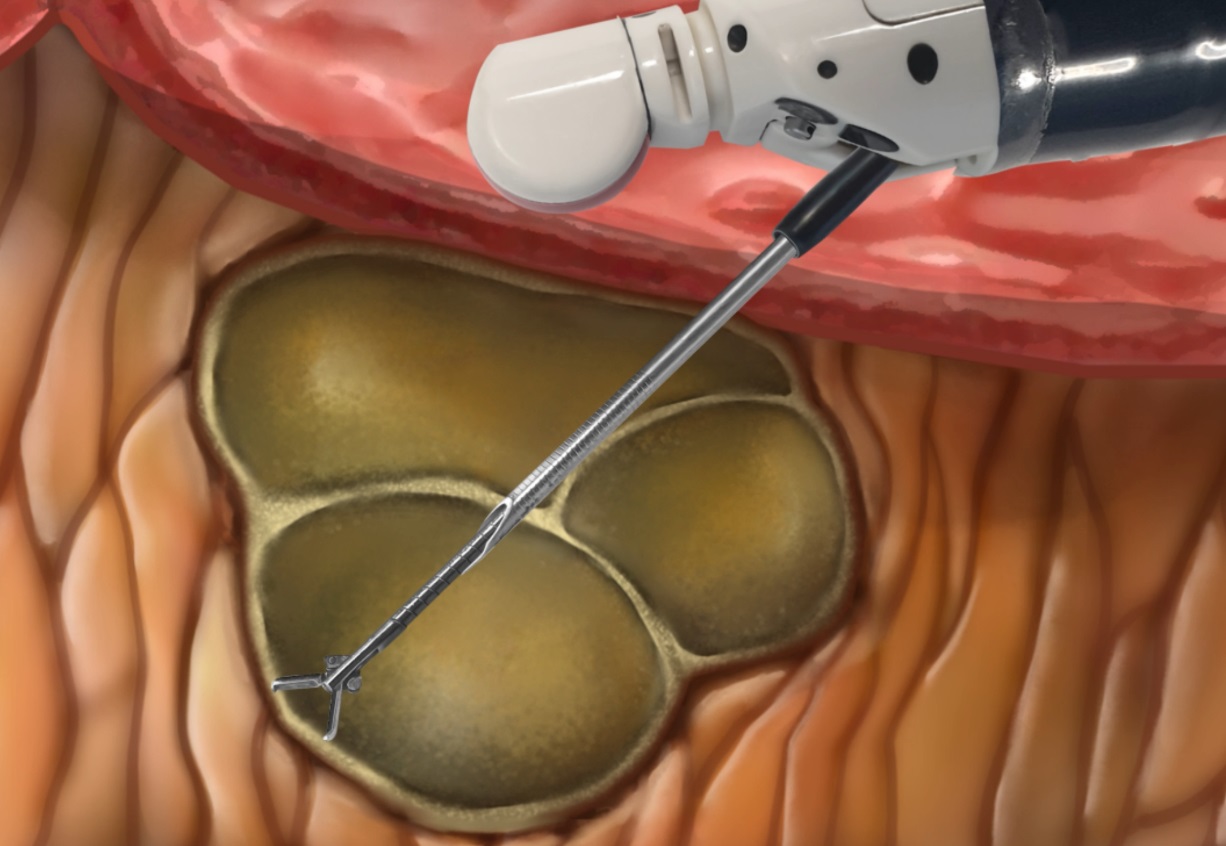 transigol'naya shchiptsovaya biopsiya