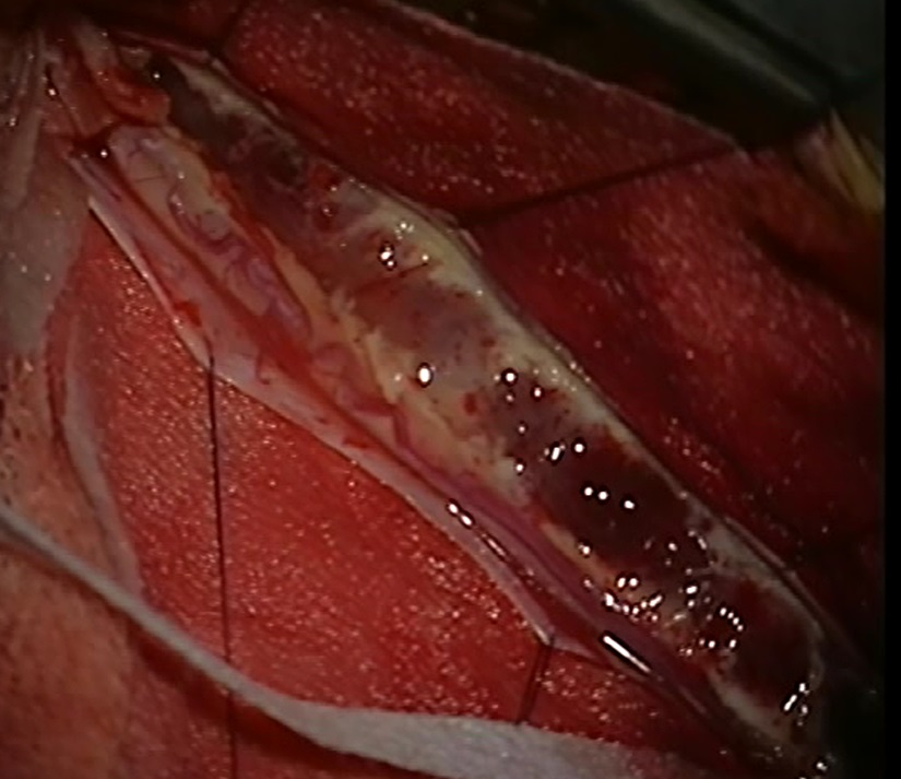 Вид опухоли после вкрытия мягкой оболочки.