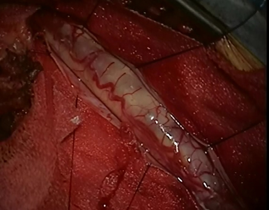 Вид после вскрытия твердой мозговой оболочки