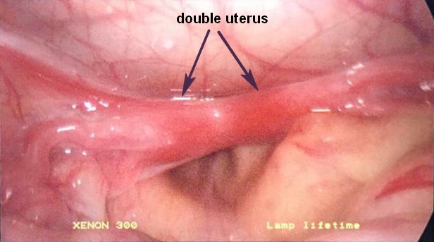 Две матки_double uterus