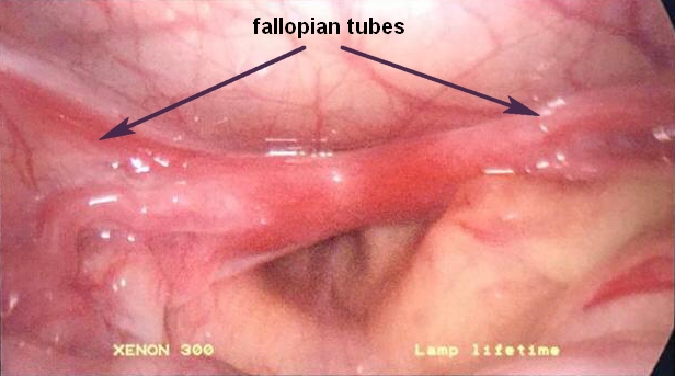 Две матки_маточные трубы_fallopian tubes