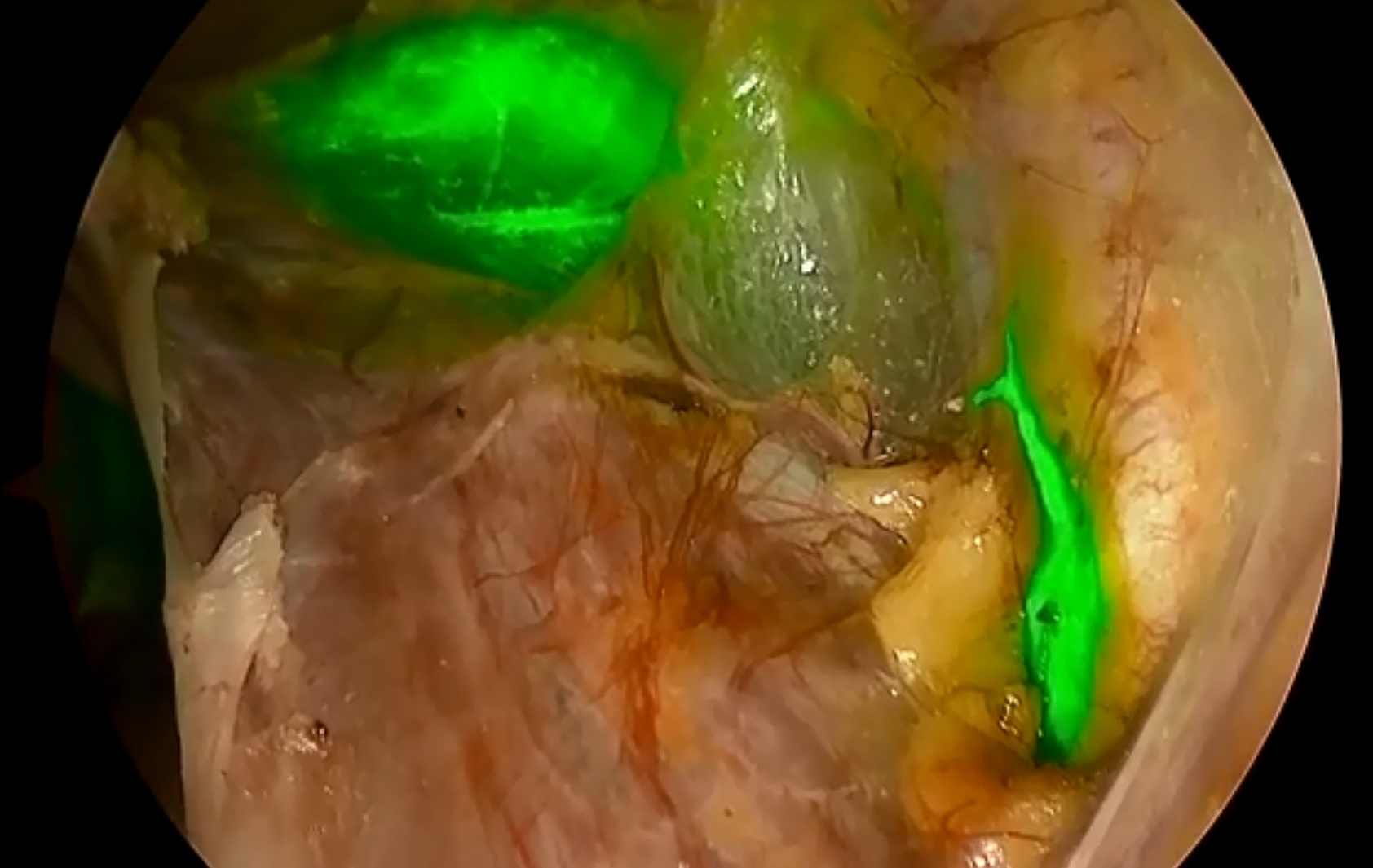 Детекция сигнльных лимфоузлов