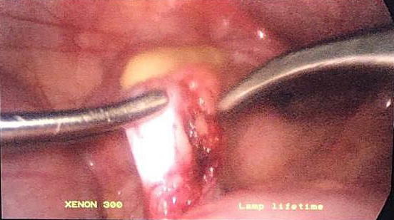 Дисгенетичная почка_0