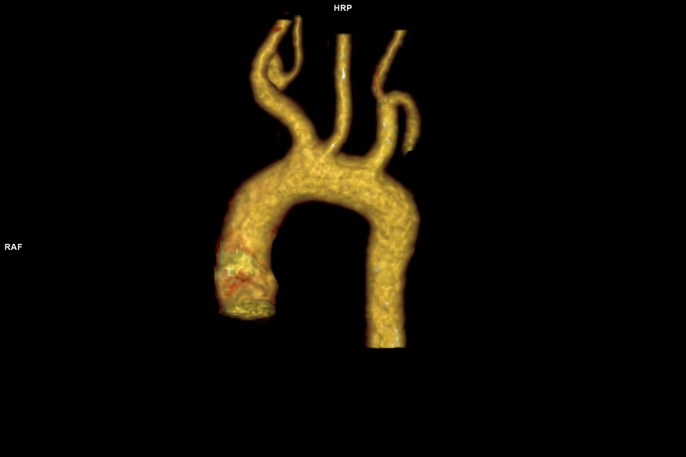 Дуга аорты после кардиохирургического лечения по данным МСКТ (2)_0