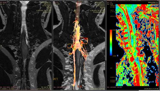 Злокачественные опухоли спинного мозга