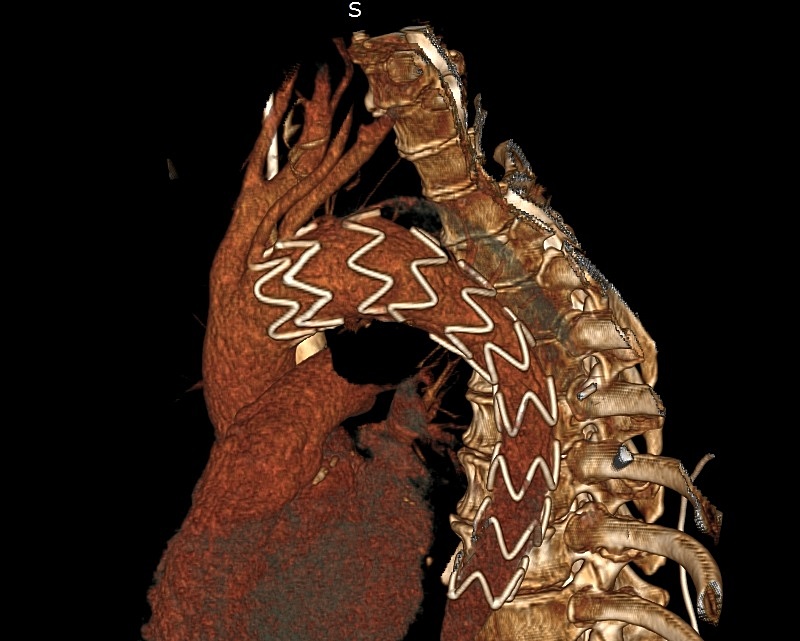 КТ-ангиография после имплантации стент-графта в грудной отдела аорты_0