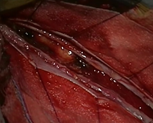 Картина после  удаления опухоли