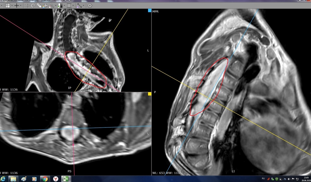 МРТ до операции_0