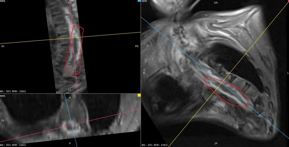 МРТ после операции_0