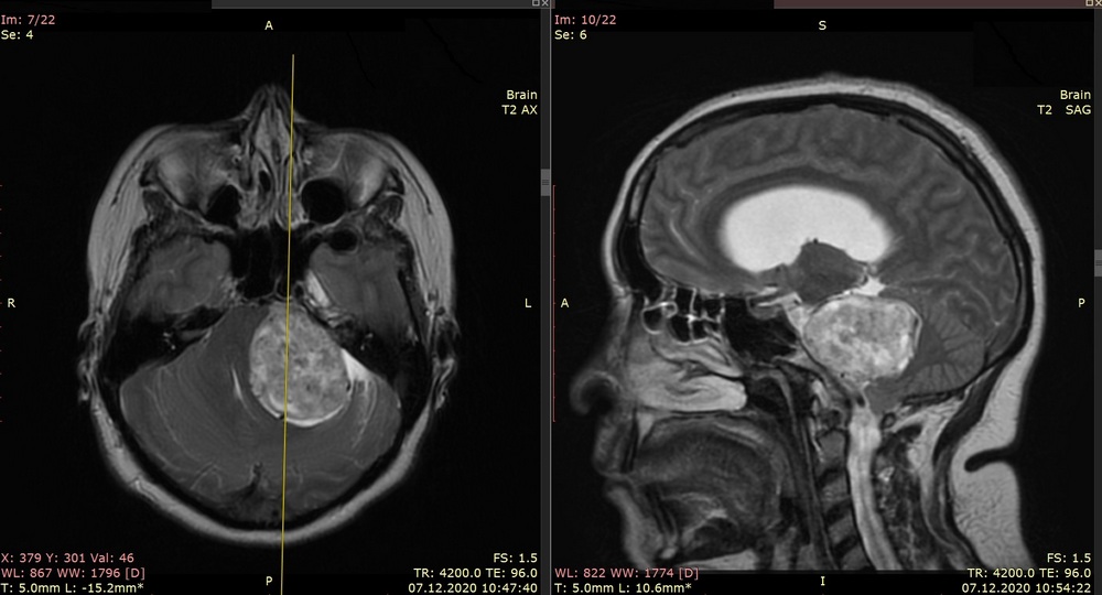 МРТ-шваннома_0