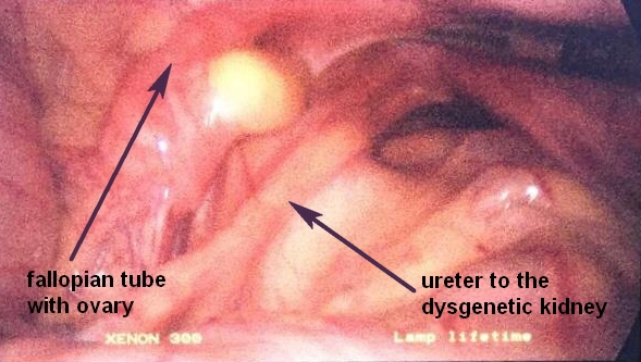 Маточная труба с яичником и мочеточник к дисгенетичной почке_allopian tube with ovary, ureter to the dysgenetic kidney