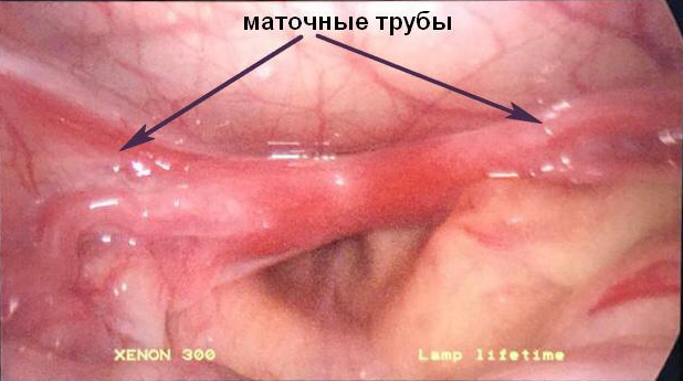 Маточные трубы_0_0_0