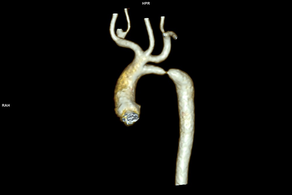 Мультиспиральная компьютерная томография грудного отдела аорты до операциии (1)_0