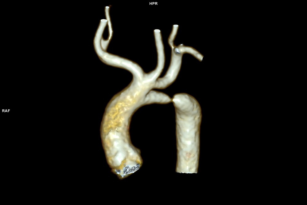 Мультиспиральная компьютерная томография грудного отдела аорты до операциии (2)_0