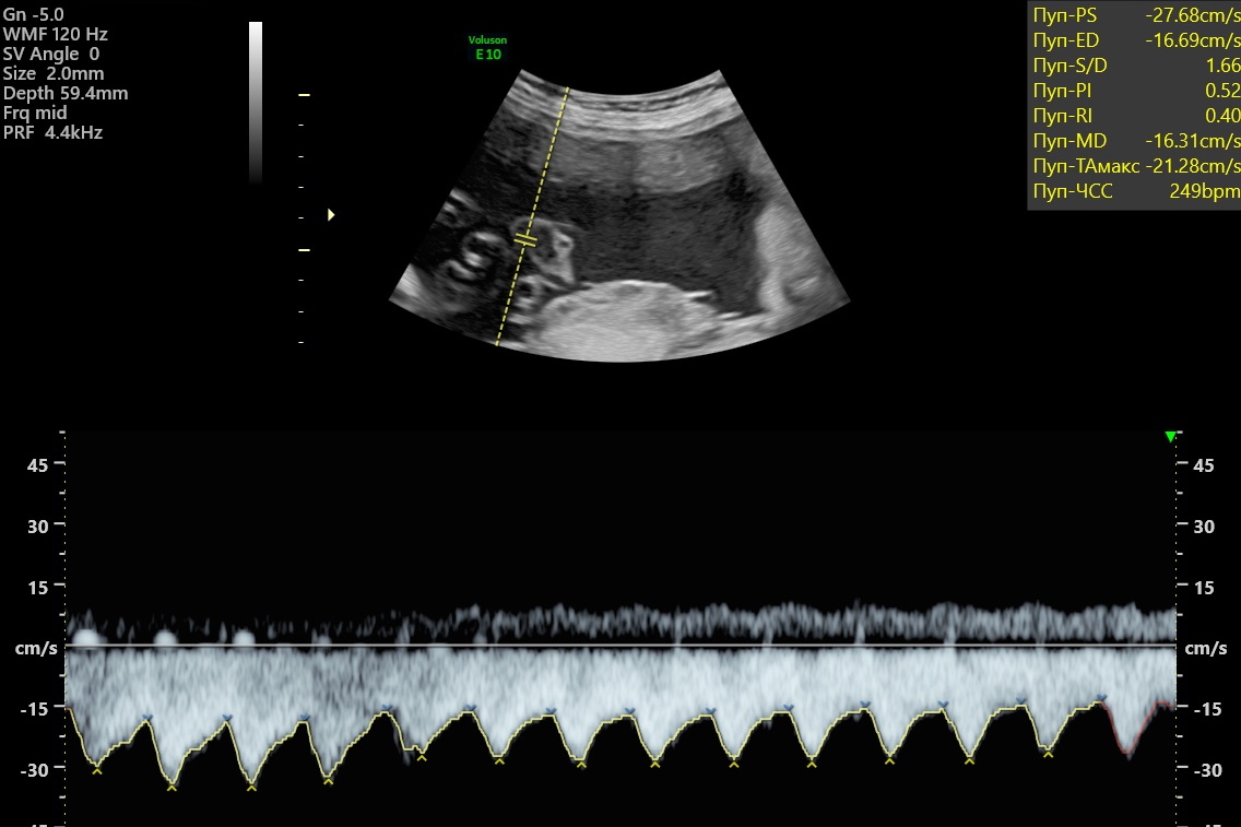 Пример внутриутробной тахикардии плода с частотой сердечных сокращений ударов 249 в минуту_0