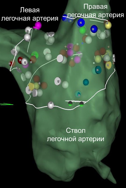 Трехмерная анатомическая реконструкция области бифуркации легочной артерии