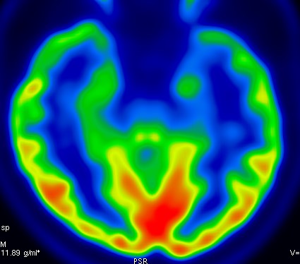 Фармакорезистентная форма эпилепсии