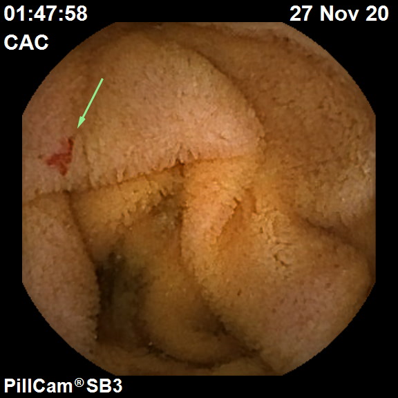 ангиоэктазия