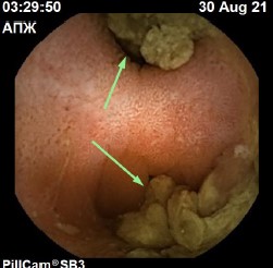 дивертикул