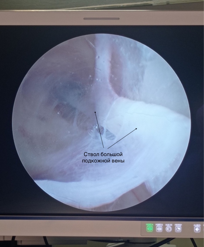 _для новости эндоскопия вена