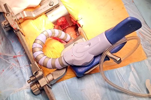 интраоперационное фото_0