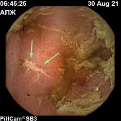 линейный язвенный дефект