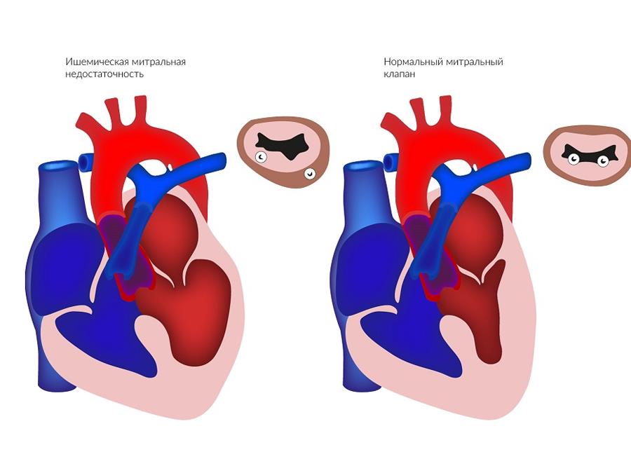 операция МитраКлип-3