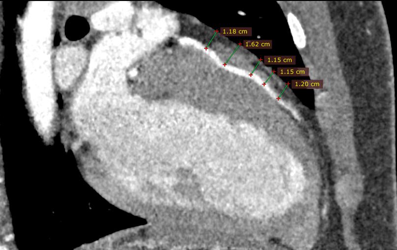 супракоронарная миотомия у ребенка-1