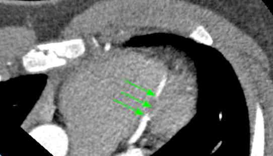 супракоронарная миотомия у ребенка-2